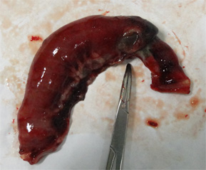 腸重積３.jpg